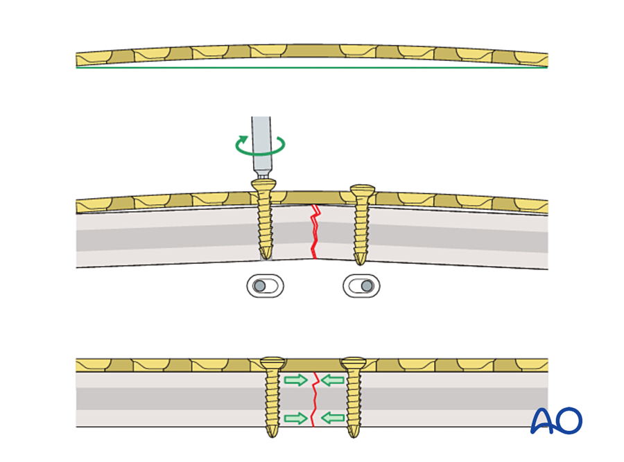 Over-bent plate compresses both cortices