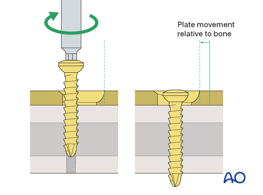 Principle of dynamic compression: the screw head slides down the slope of the hole