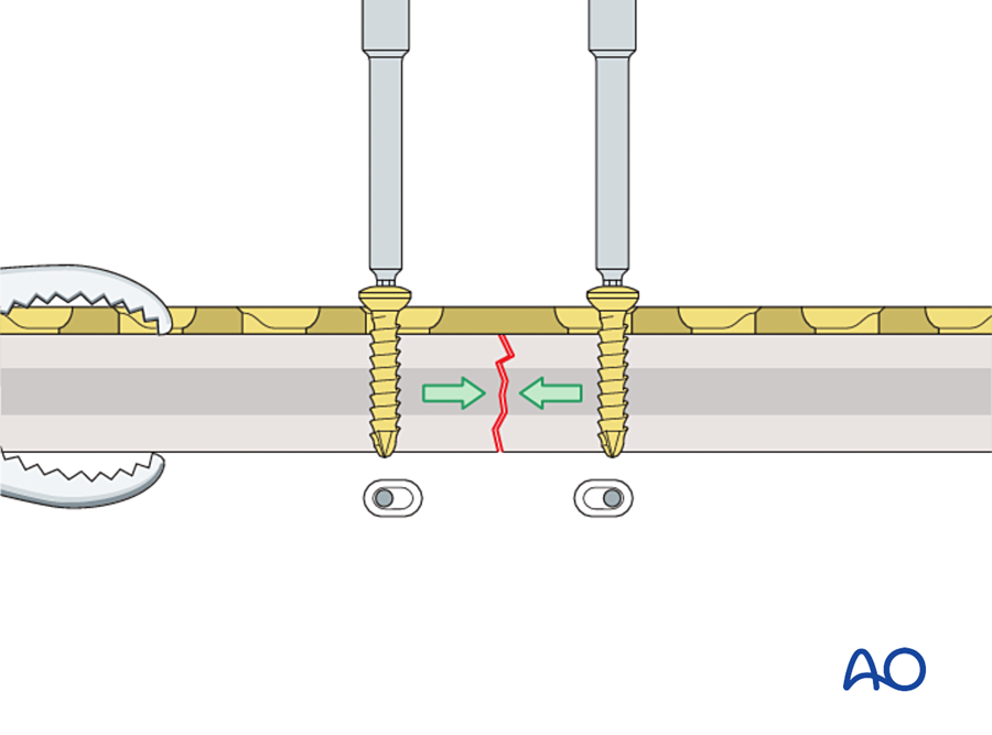 Two screws in compression mode, one on each side of the fracture