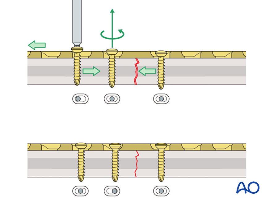A third compression screw closes a remaining gap