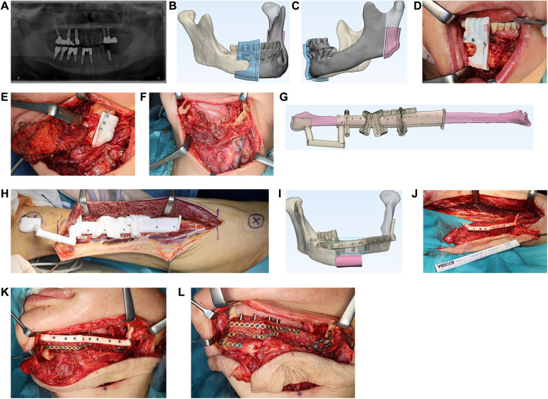 Planned and guided mandibular reconstruction with a fibula flap, step by step