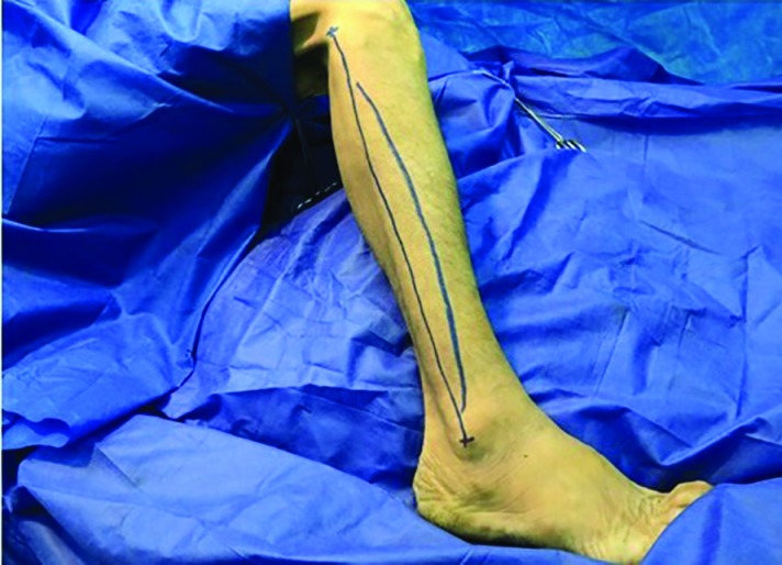 Cadaver leg with the fibula flap marked