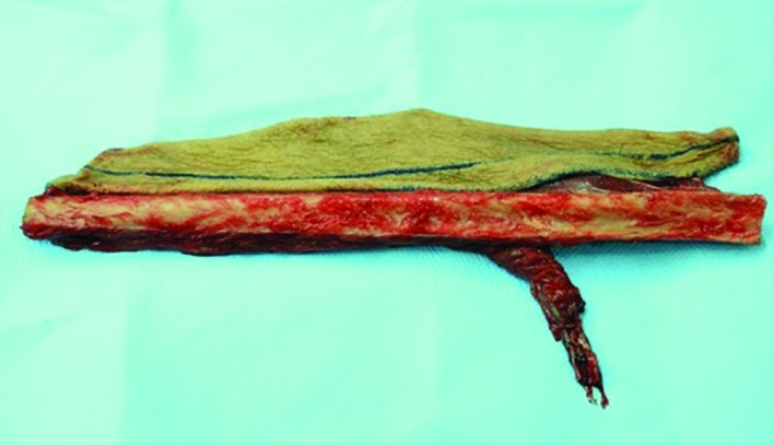 Harvested fibula osteocutaneous flap