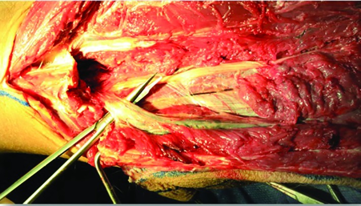 Cadaver dissection of the peroneal vessels