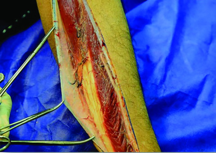 Cadaver dissection showing septocutaneous perforators