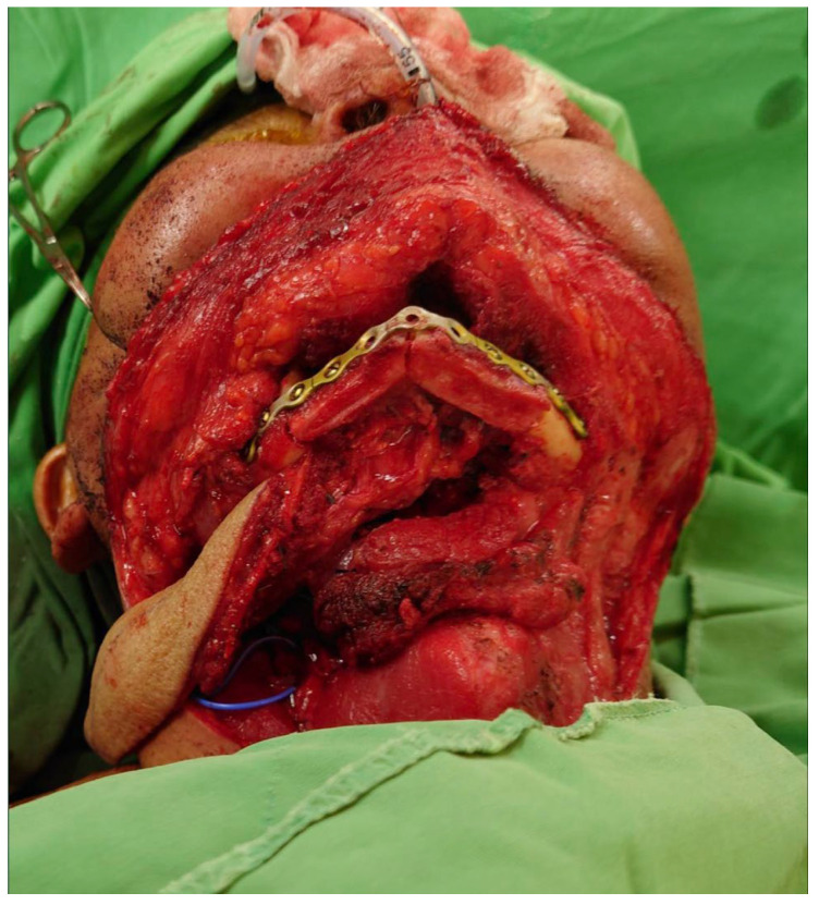 Fibula flap inset with skin replacing oral mucosa and chin skin