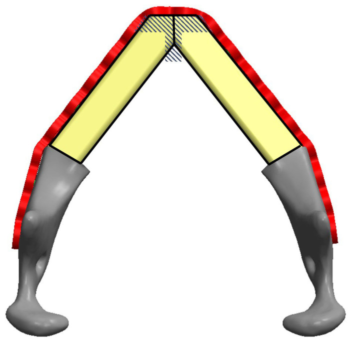 Drawing of two fibula segments fitted to a bent reconstruction plate