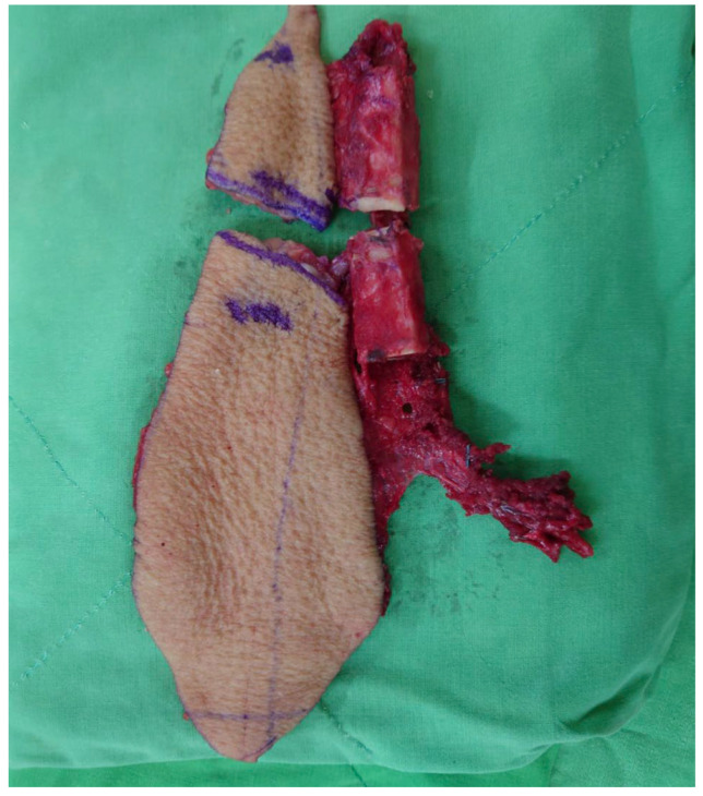 Fibula flap with two skin islands and two bone segments