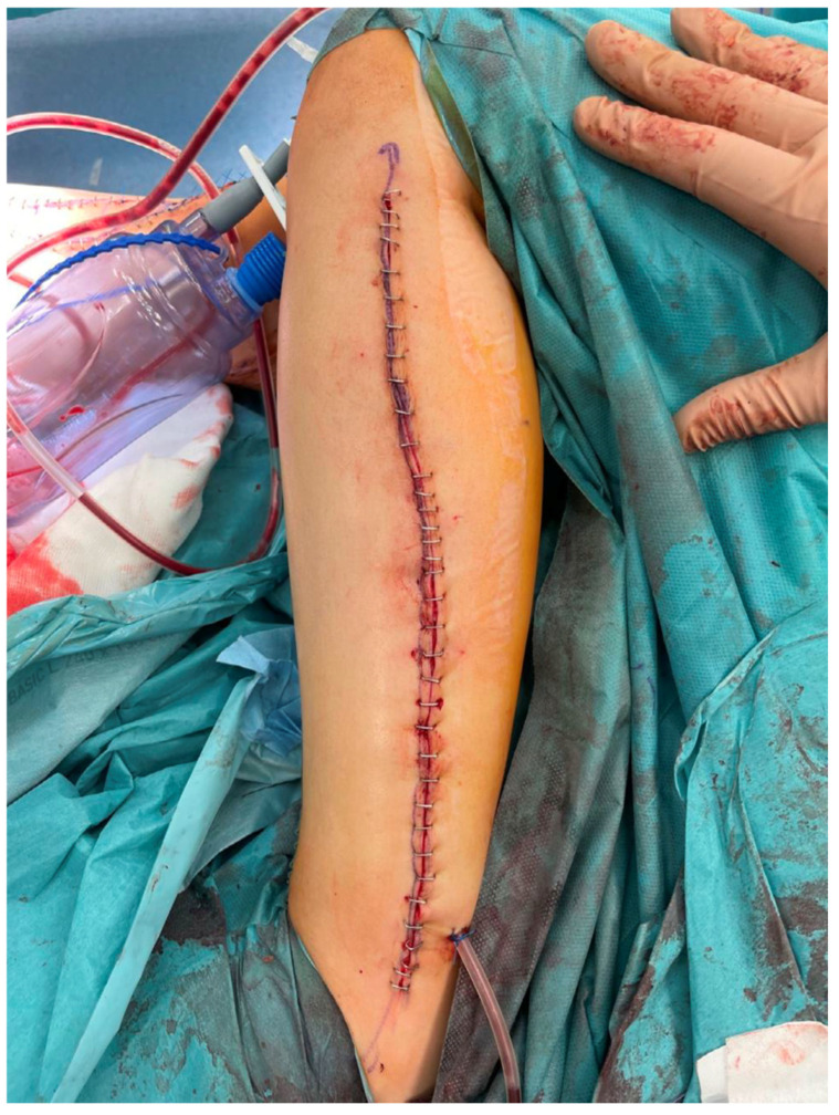 Donor leg closed directly with a drain