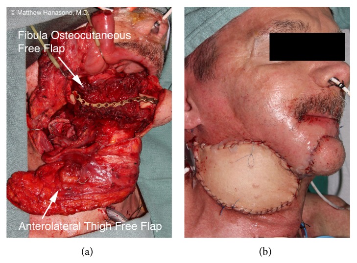 Fibula flap with an anterolateral thigh flap for the external skin