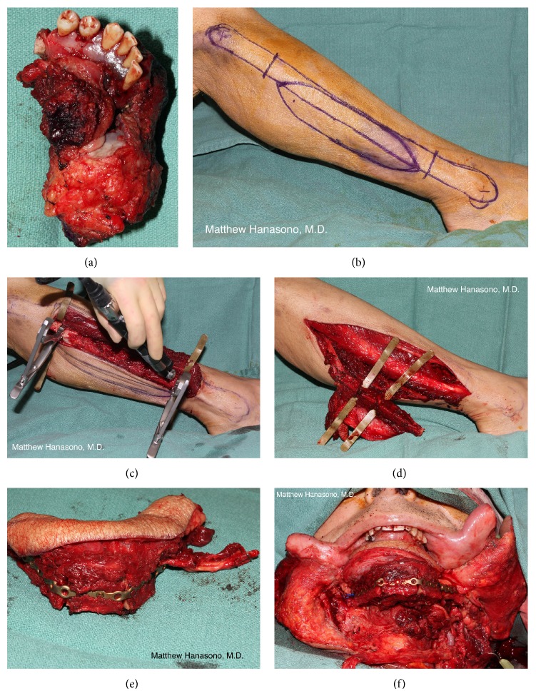 Sequence of a fibula flap reconstruction of an anterior mandibular defect
