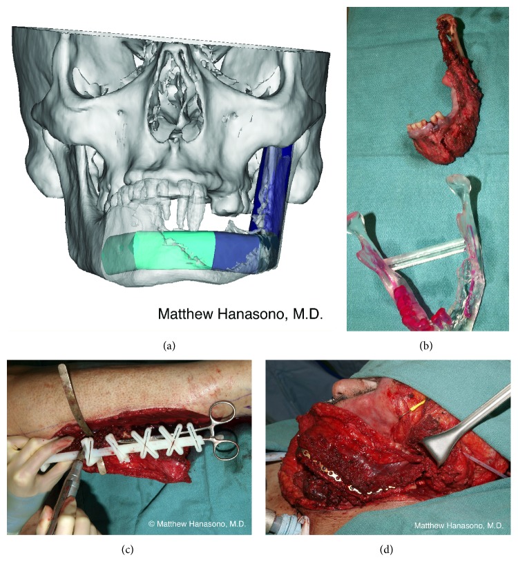 Virtual surgical planning for a fibula flap
