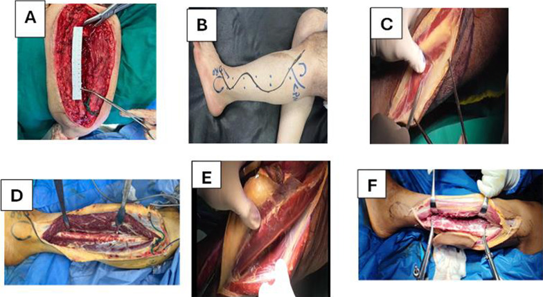Clinical photographs of the first steps of fibula flap harvest