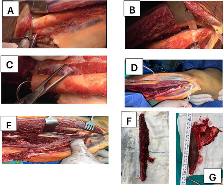 Clinical photographs of the later steps of fibula flap harvest