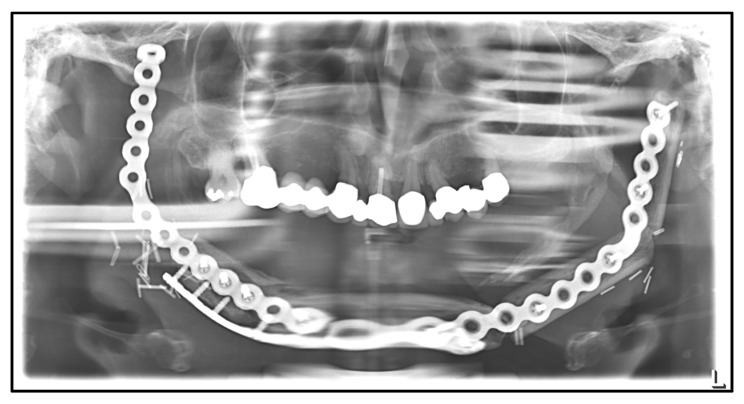 Panoramic radiograph showing a fractured reconstruction plate
