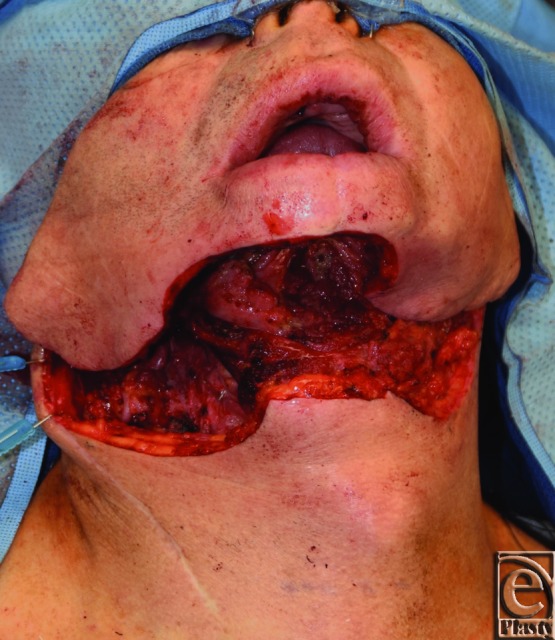 Through-and-through defect of the chin and anterior mandible