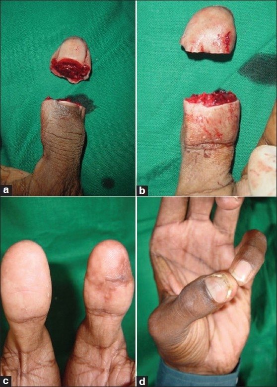 Fingertip replantation