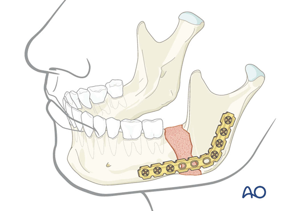Bridging an infected fracture