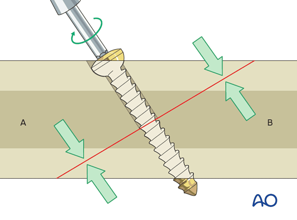 How a lag screw compresses