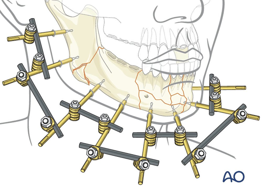 External fixator on the mandible
