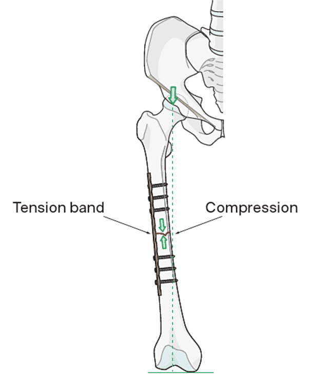 Tension band principle