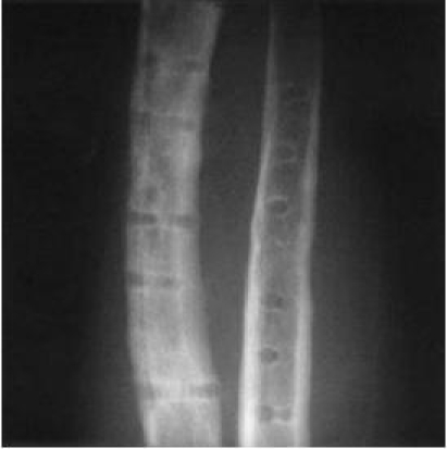 Radiograph showing cortical bone loss under a rigid plate
