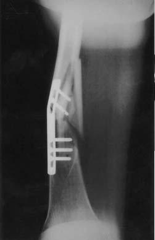 Radiograph of a failed Eggers plate