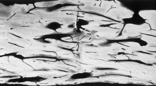 Histology of primary bone healing