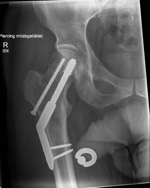 Sliding hip screw with side plate
