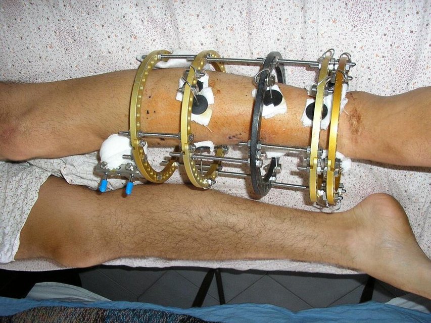 A circular frame on the leg