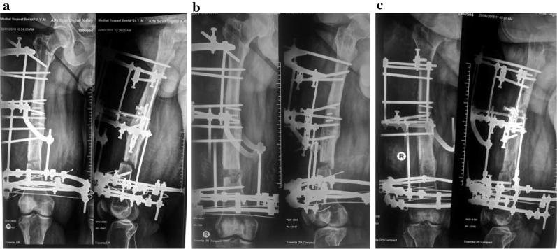 Femoral lengthening: three phases