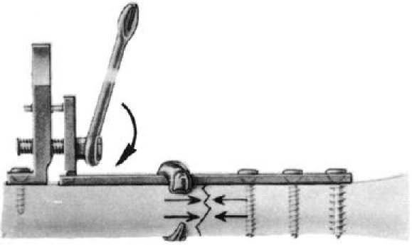 Müller's tensioner plate (1965)