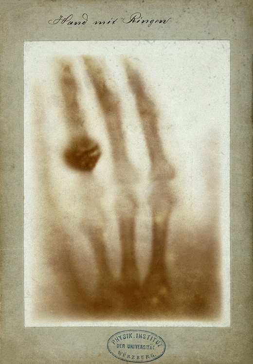 Röntgen's first medical radiograph
