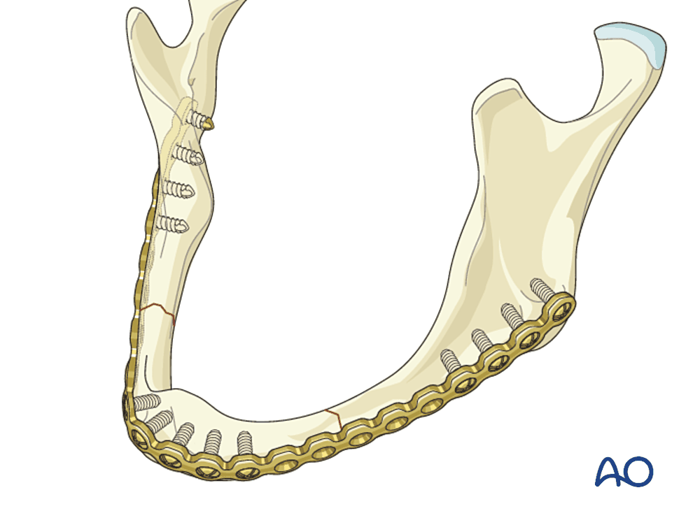 Reconstruction plate on an atrophic mandible