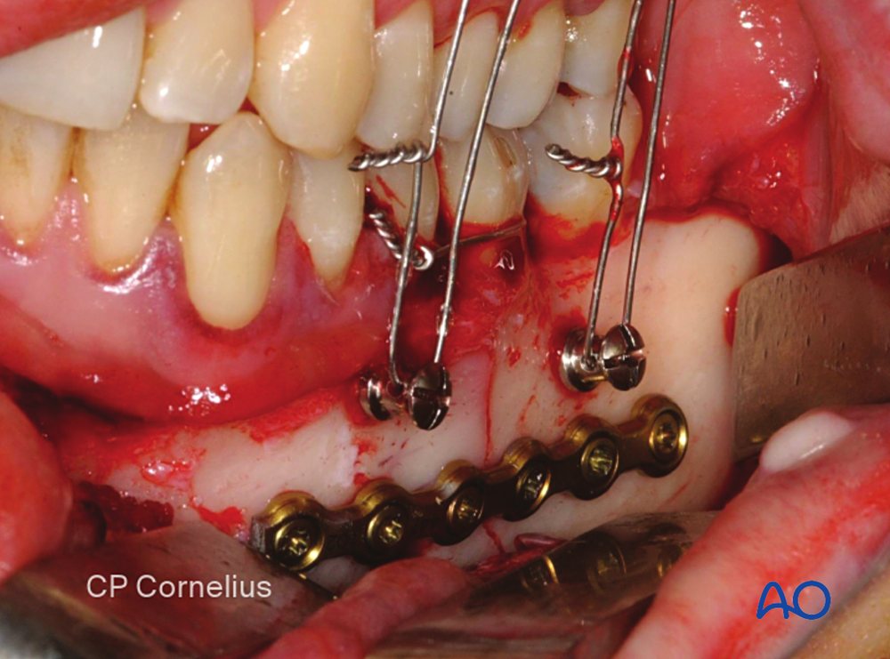 Miniplate on a mandibular body fracture