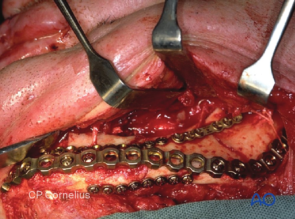 Reconstruction plate on a comminuted mandibular fracture