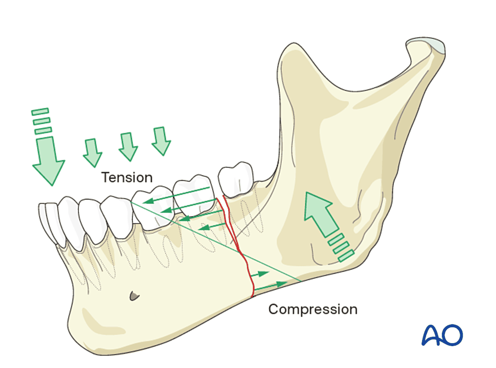 Tension and compression zones of the mandible