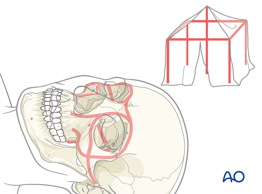 Midface buttresses drawn as tent poles