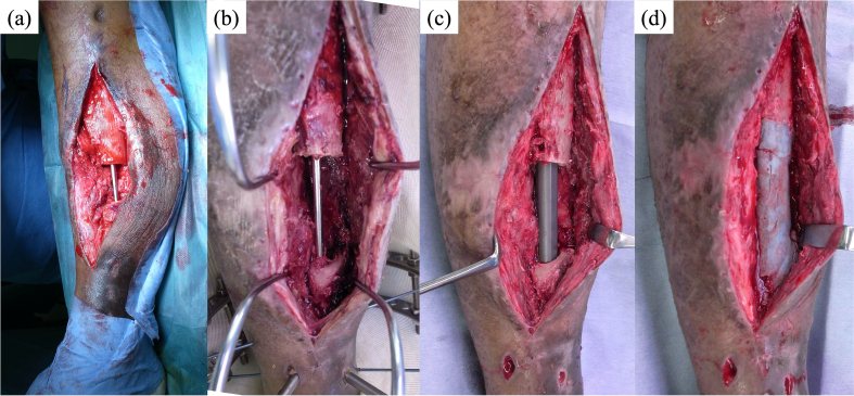 Cement spacer in a tibial defect