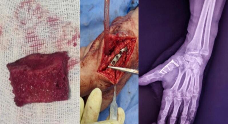 Second stage in a thumb metacarpal defect