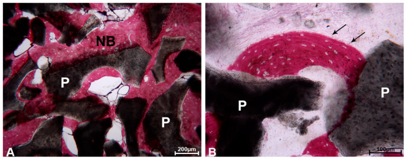Histology showing new bone on the surface of graft particles