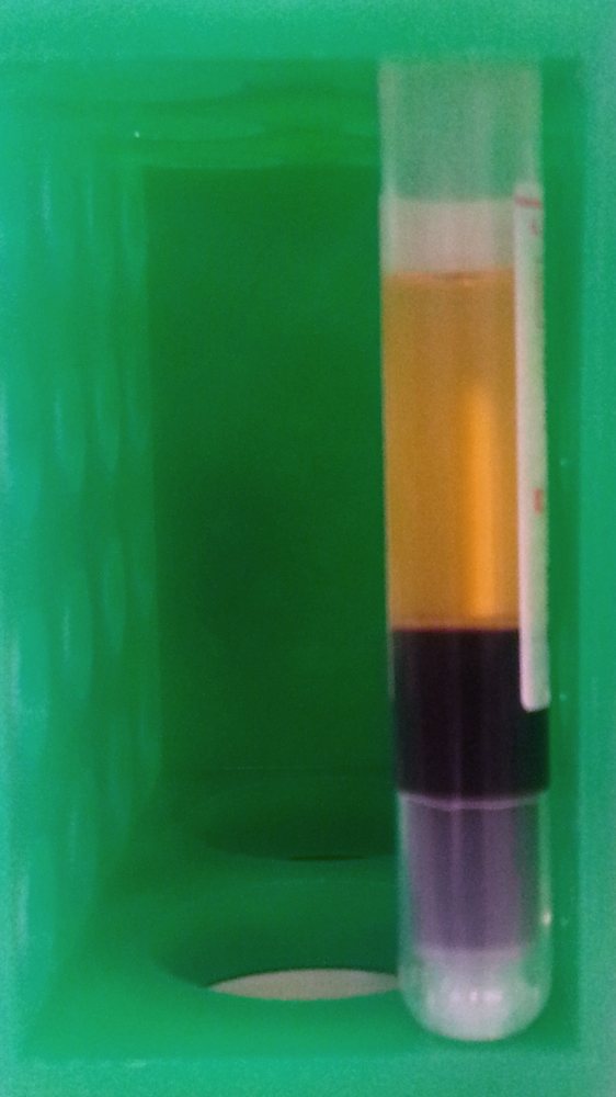 Blood separated into layers after centrifugation