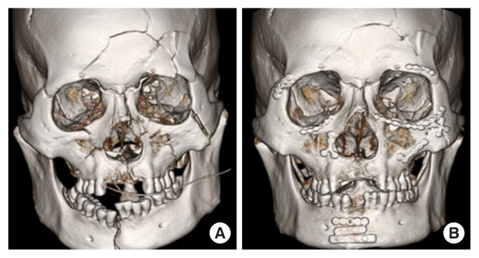 3D CT before and after panfacial fixation