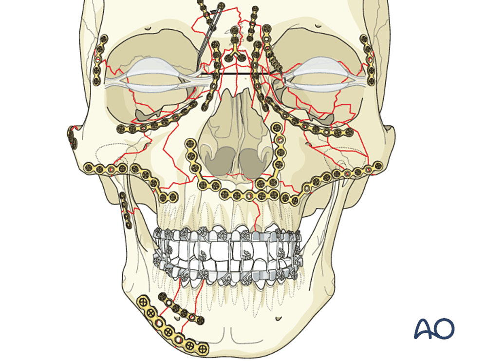 Panfacial fixation along the buttresses
