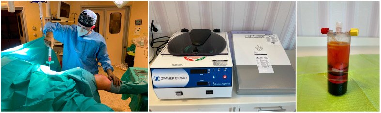 Bone marrow aspiration, centrifuge and concentrated marrow