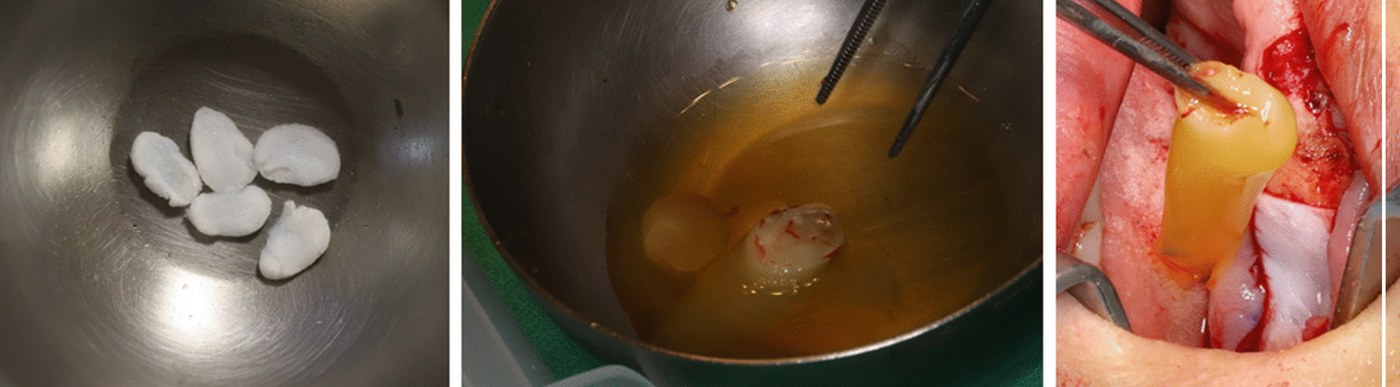 Collagen sponges soaked in rhBMP-2 solution and placed on bone