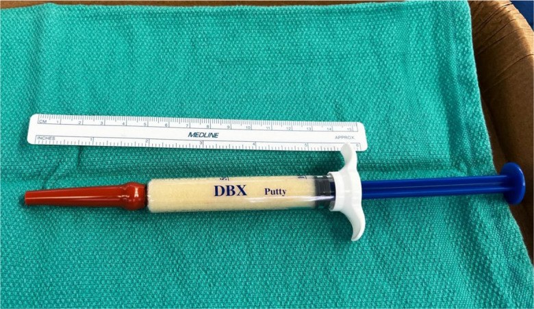 Demineralized bone matrix putty in a syringe