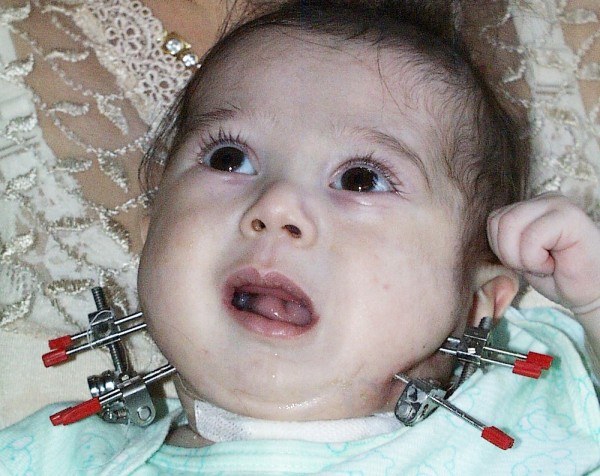 Infant with bilateral external mandibular distractors