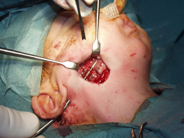 Internal mandibular distraction device fixed across the osteotomy