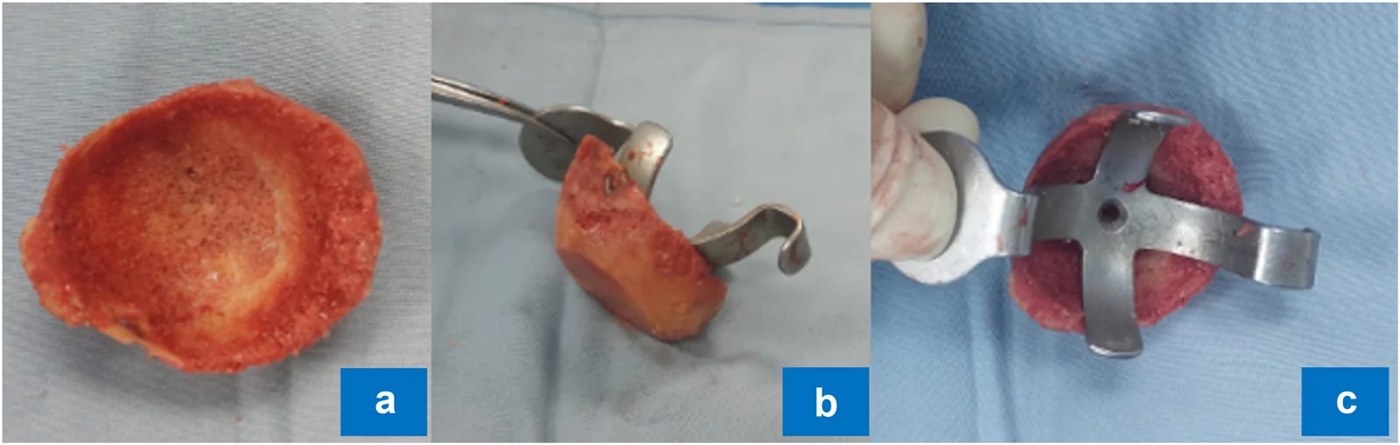 Femoral head allograft being shaped
